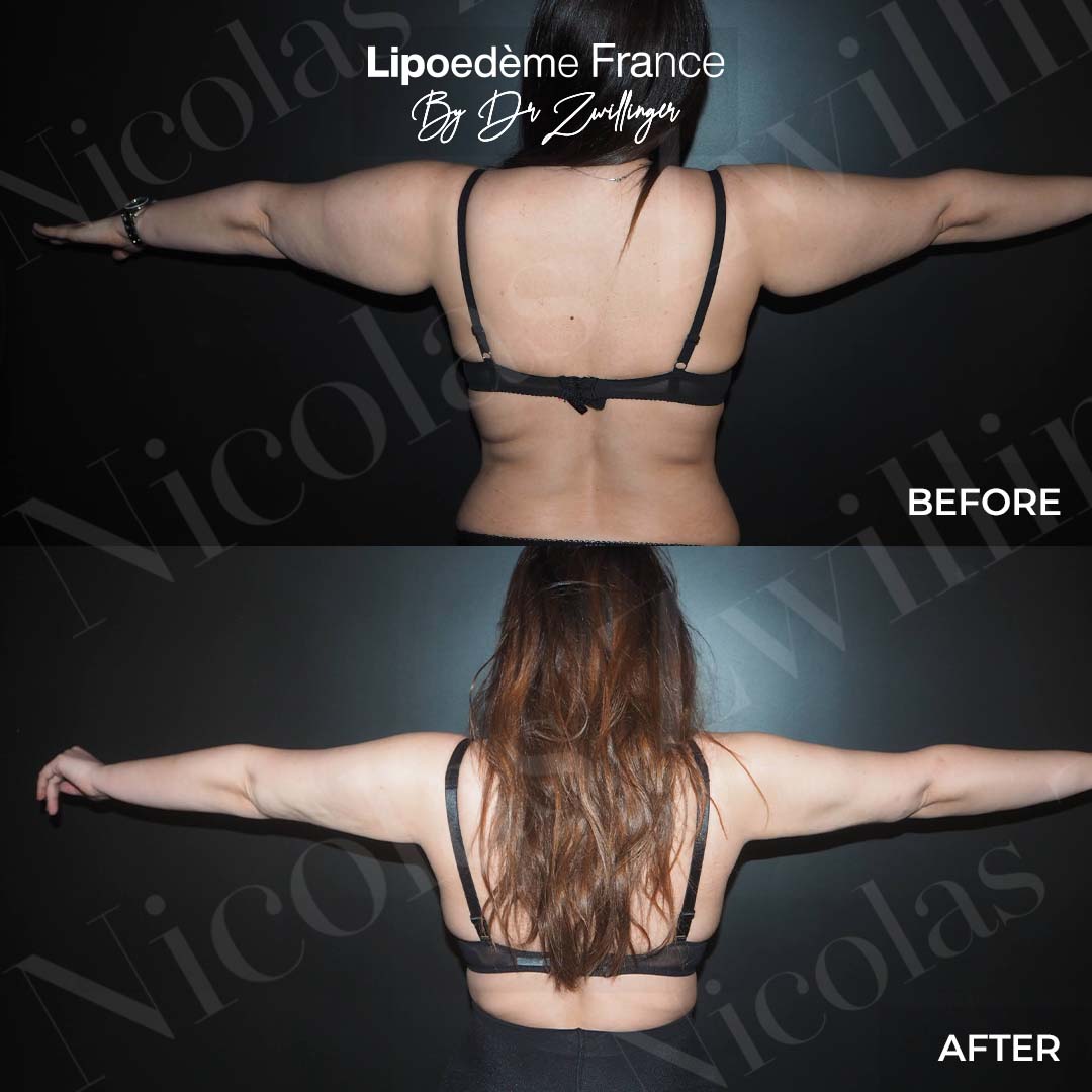 Avant / après bras